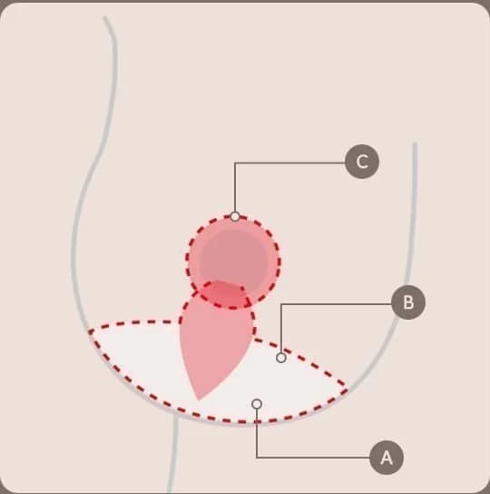 显示乳房提升手术切口与移动方向的示意图