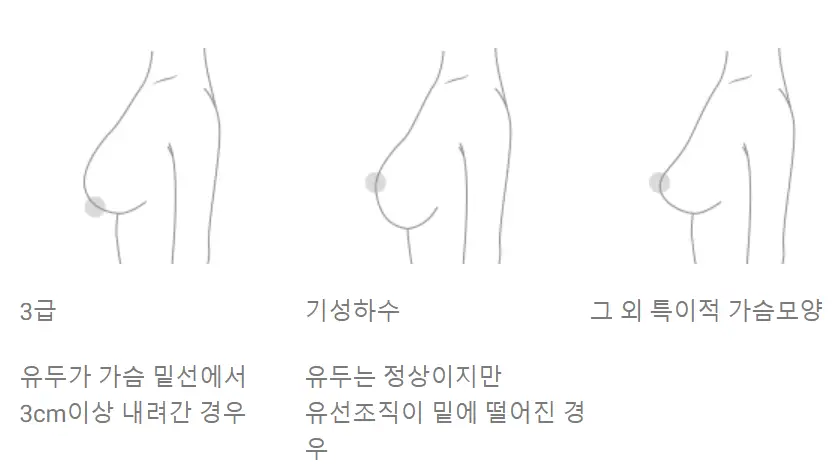 乳房提升手术费用?先打听价格也没有意义的原因。 — 正文图片 4