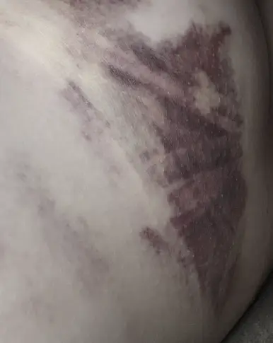 胸部手术恢复期,可能使恢复延误一周以上的2种并发症 <以20年研究经验给您的建议> — 본문 이미지