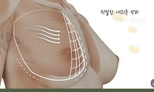 鸡胸手术,做了隆胸会不会没有乳沟只是变大 <基于20年研究经验的建议> — 본문 이미지