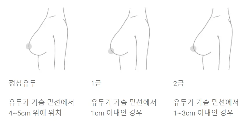 乳房提升手术费用?先打听价格也没有意义的原因。 — 正文图片 3