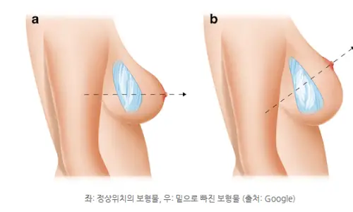 假体下移(bottoming out)修复手术?腋下切口/乳房下皱襞切口方式总整理 <来自20年研究经验的建议> — 본문 이미지