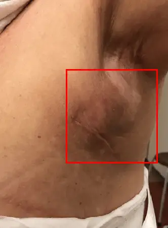 胸部手术恢复期,可能使恢复延误一周以上的2种并发症 <以20年研究经验给您的建议> — 본문 이미지