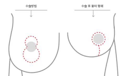 乳房下垂手术费用,以及需要提升术/假体的情况,一并为您整理。<来自20年研究经验的建议> — 正文图片 5