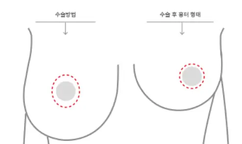 乳房下垂手术费用,以及需要提升术/假体的情况,一并为您整理。<来自20年研究经验的建议> — 正文图片 6