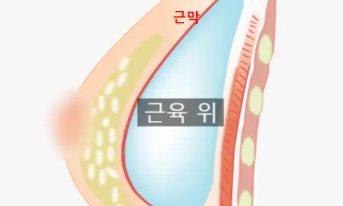 隆胸后的触感,会因疤痕而变化?分享经论文证实的事实。 — 본문 이미지