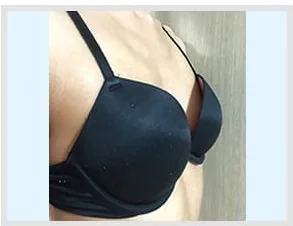 隆胸术前侧面照片3
