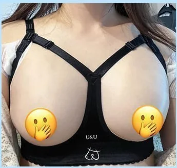 隆胸术后第2天佩戴塑形文胸的正面照片1