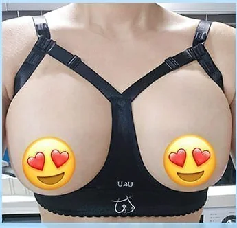 隆胸术后第2天佩戴塑形文胸的正面照片6