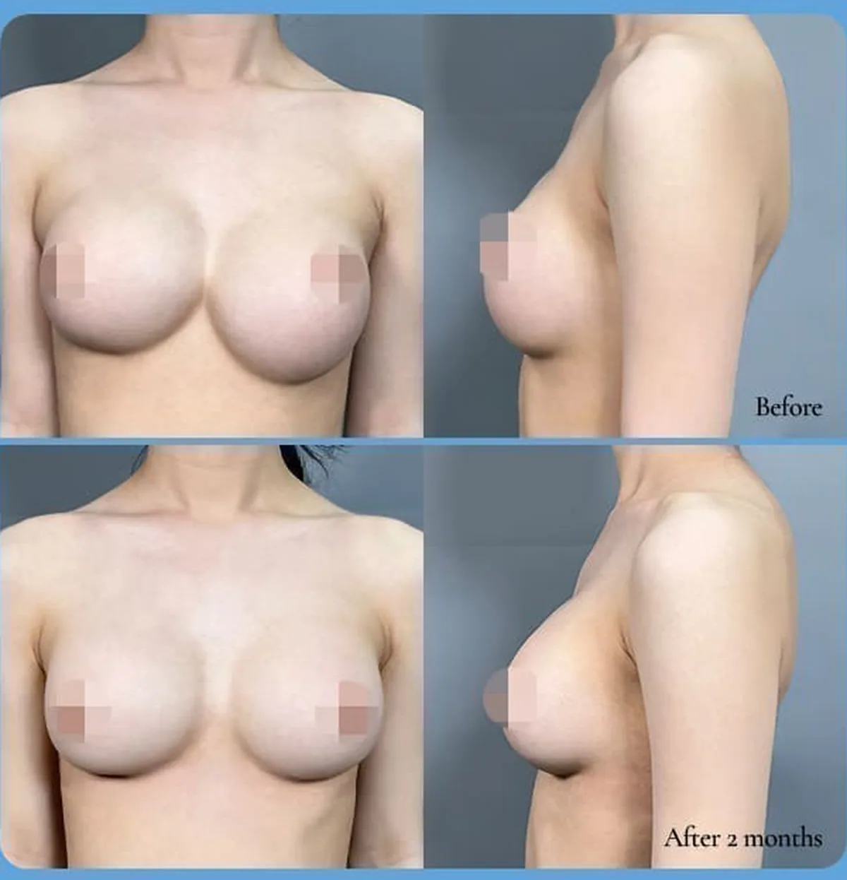 前移(并乳症)·假体下移修复手术前后对比照片 — Before / After 2 months(正面·侧面)
