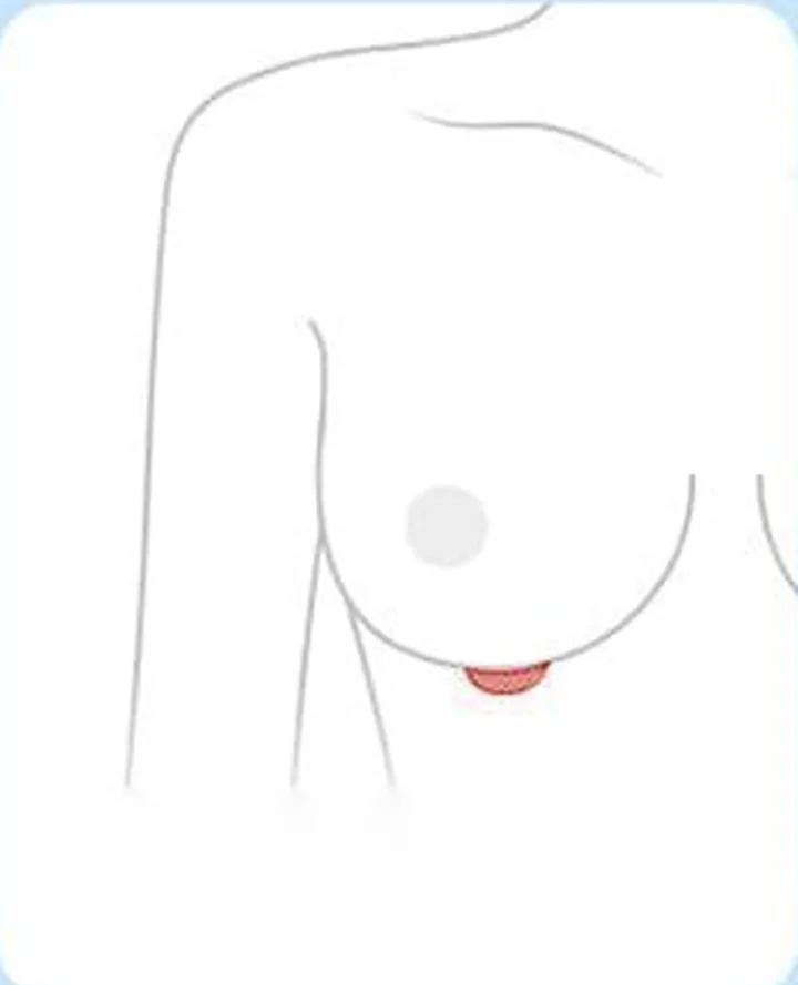 标示乳房下皱襞切口位置的图解
