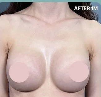 乳沟补充治疗1个月后的正面照片