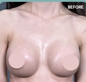 乳沟补充治疗前的正面照片
