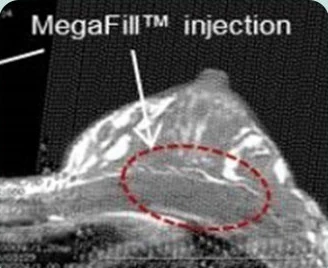 MegaFill™ injection — 胸部侧面CT影像上标示移植部位