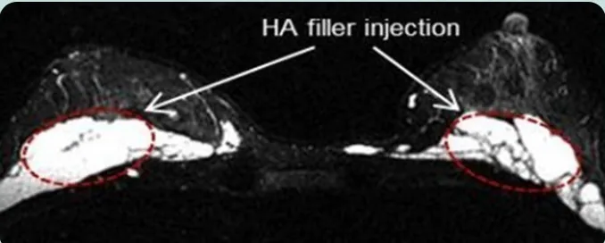 HA filler injection — 双侧乳房MRI轴位图像上标示填充剂注射部位