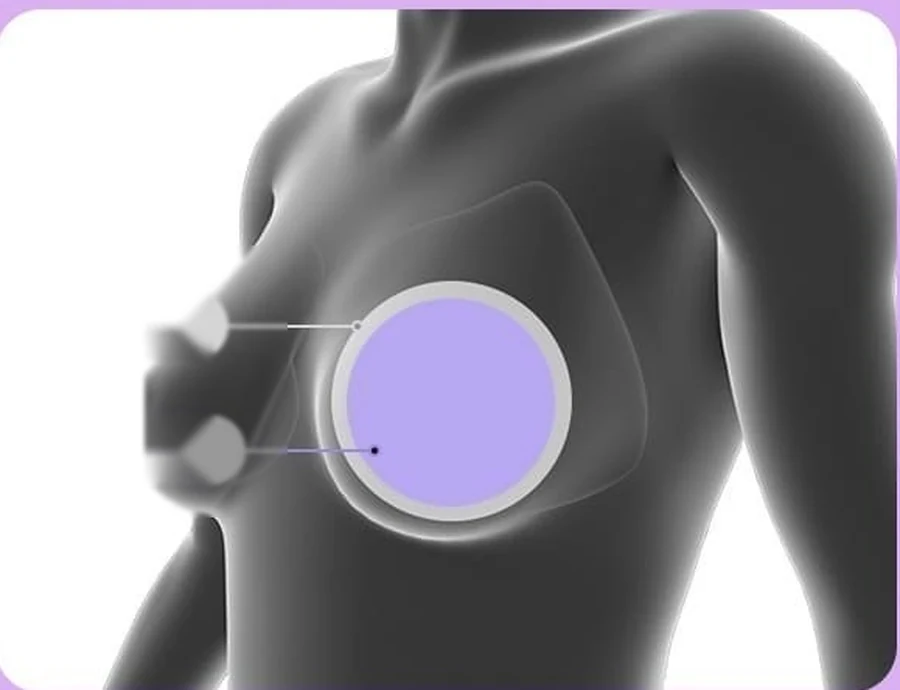 乳房断面图解 — 在胸大肌下方剥离出的乳房腔隙及置于其中的圆形假体