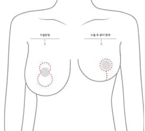 标示垂直切开位置与术后疤痕形态的上半身示意图