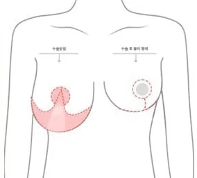 标示O字切开范围与术后疤痕形态的上半身示意图