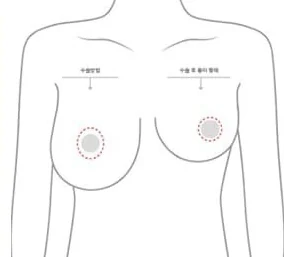 标示乳晕切开位置与术后疤痕形态的上半身示意图