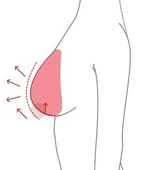 在植入假体的同时上提乳头位置的胸部提升侧面示意图