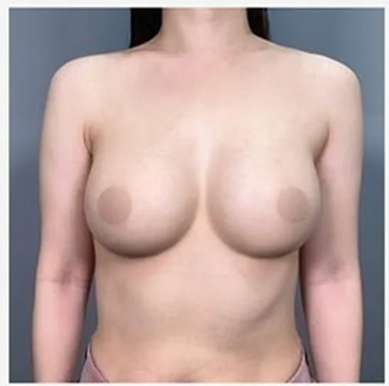 单侧乳房修复手术后正面照片1