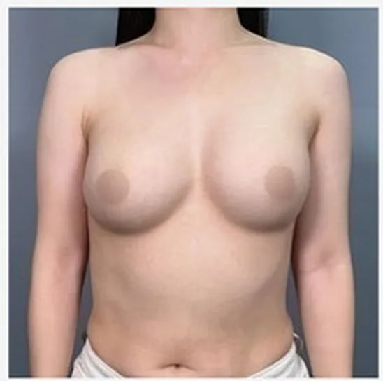 单侧乳房修复手术前正面照片1