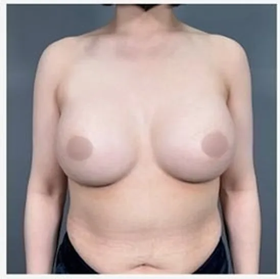 单侧乳房修复手术后正面照片2