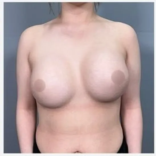 单侧乳房修复手术前正面照片2
