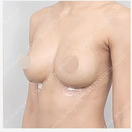 单侧乳房修复手术后侧面照片3