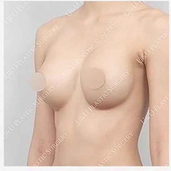 单侧乳房修复手术前侧面照片3