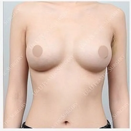 单侧乳房修复手术后照片5