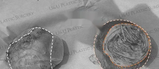 取出物照片 — 整体(Em Bloc)摘除的包膜与破裂假体并排摆放