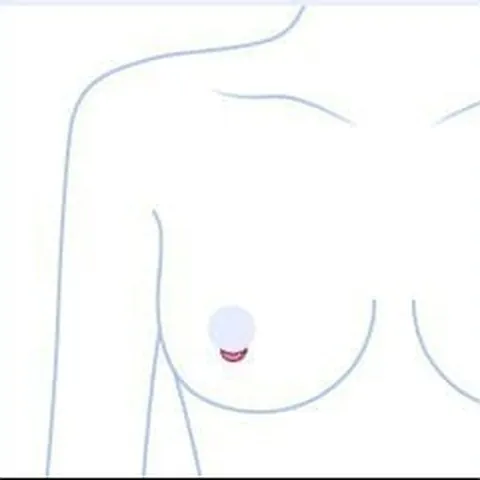 标示乳晕切口位置的上半身插图