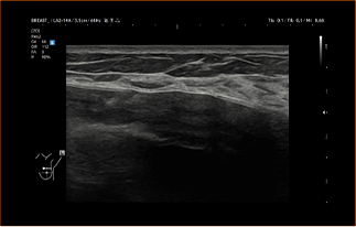Healthy Breast 假体超声 img10 m
