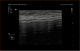 Healthy Breast 假体超声 img11 m