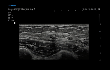 Healthy Breast 假体超声 img5 m
