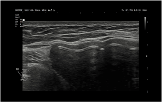 Healthy Breast 假体超声 img6 m