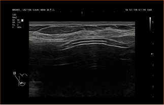 Healthy Breast 假体超声 img7 m
