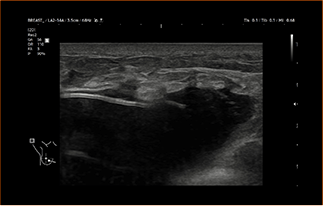 Healthy Breast 假体超声 img8 m