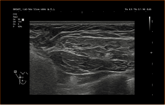 Healthy Breast 假体超声 img9 m