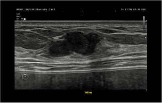 Healthy Breast 乳腺癌超声 img10 m