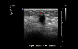 Healthy Breast 乳腺癌超声 img11 m