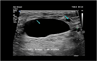 Healthy Breast 乳腺癌超声 img12 m