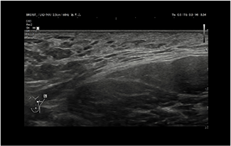 Healthy Breast 乳腺癌超声 img13 m