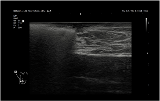 Healthy Breast 乳腺癌超声 img14 m