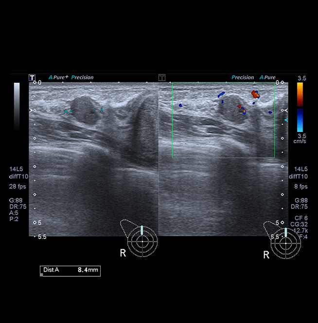 Healthy Breast 乳腺癌超声 img17 m
