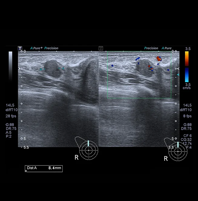 Healthy Breast 乳腺癌超声 img17 m