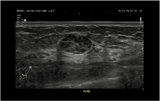 Healthy Breast 乳腺癌超声 img9 m