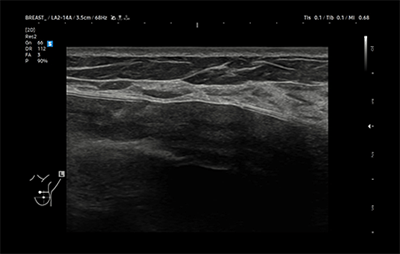 healthy breast 假体超声 img10