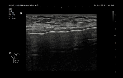 healthy breast 假体超声 img11